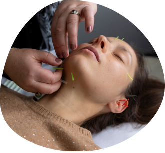 Face & body acupuncture