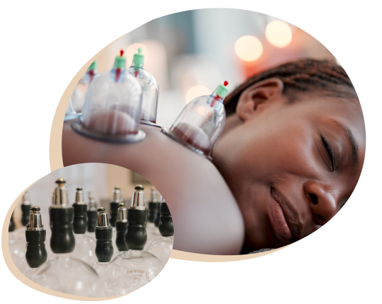 Acupuncture and Cupping